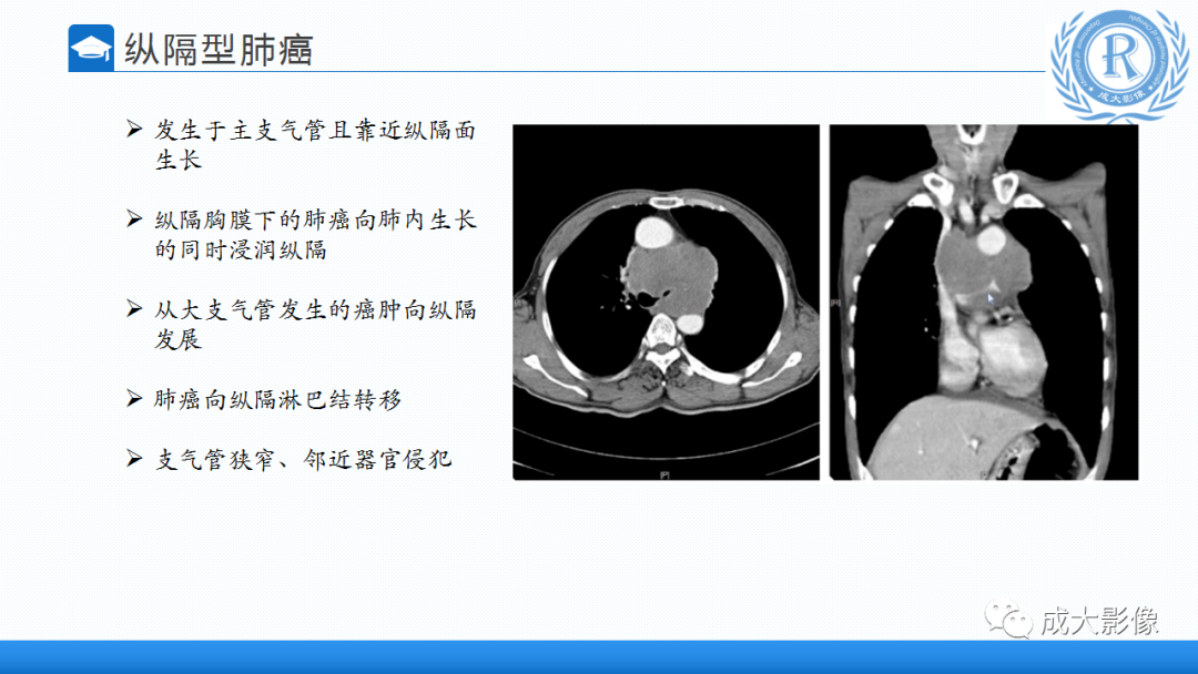 影像PPT - 【PPT】纵隔常见肿瘤及瘤样病变的诊断思路-33