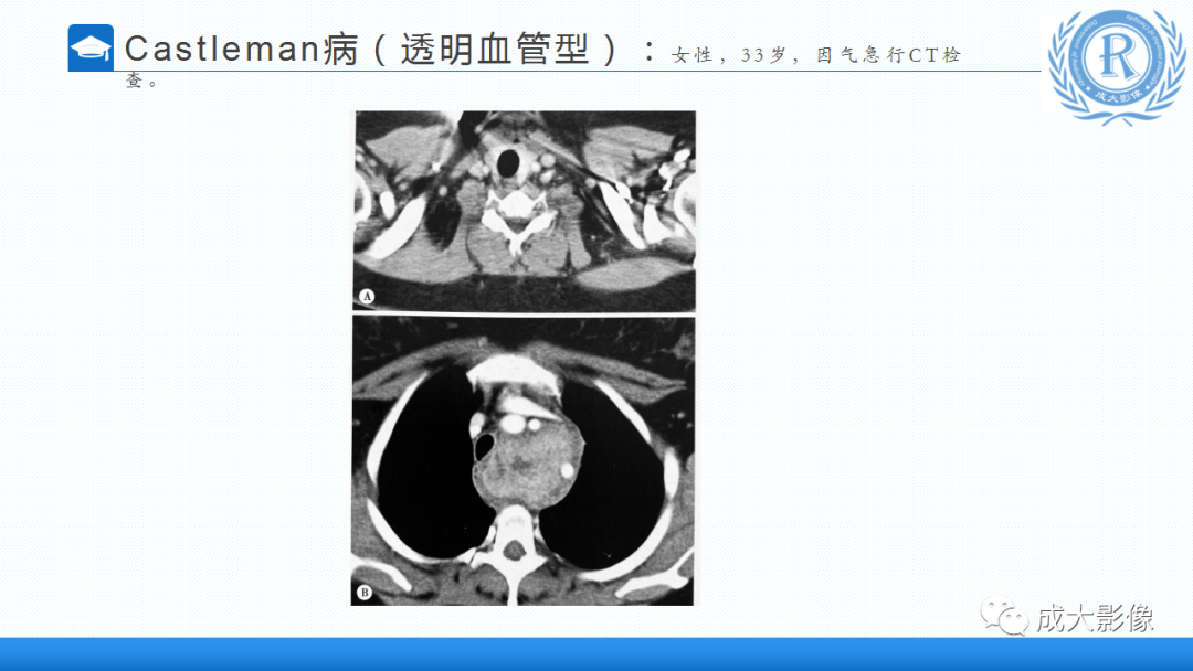 影像PPT - 【PPT】纵隔常见肿瘤及瘤样病变的诊断思路-32
