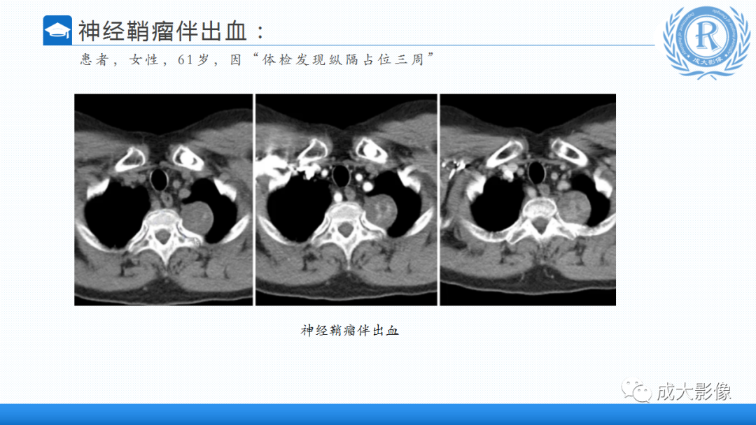 影像PPT - 【PPT】纵隔常见肿瘤及瘤样病变的诊断思路-38