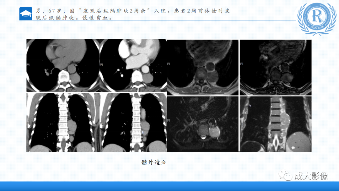 影像PPT - 【PPT】纵隔常见肿瘤及瘤样病变的诊断思路-41