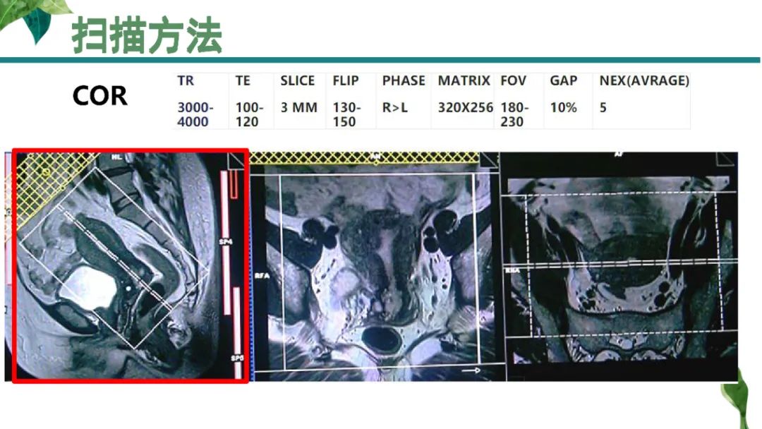 影像PPT - 【PPT】子宫内膜病变MRI诊断-3