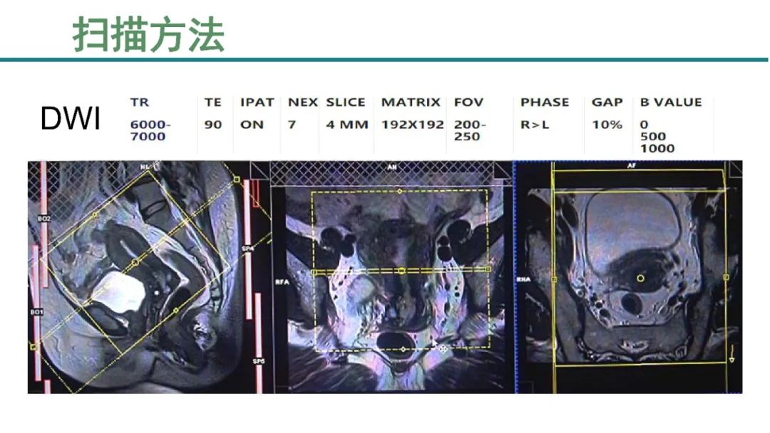 影像PPT - 【PPT】子宫内膜病变MRI诊断-6