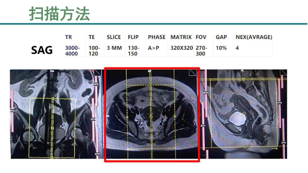 影像PPT - 【PPT】子宫内膜病变MRI诊断-4