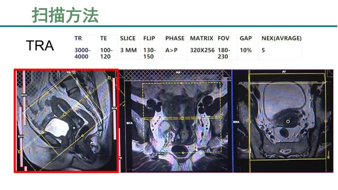 影像PPT - 【PPT】子宫内膜病变MRI诊断-5
