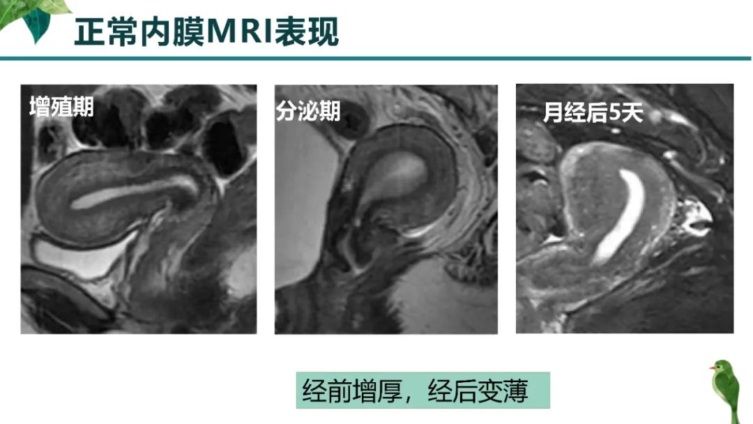 影像PPT - 【PPT】子宫内膜病变MRI诊断-10