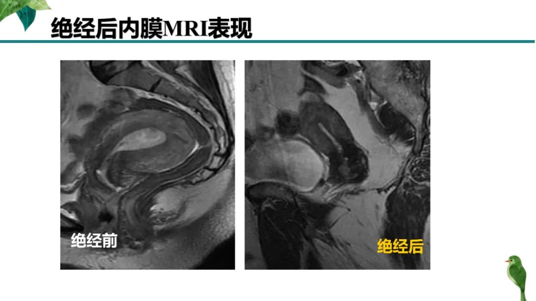 影像PPT - 【PPT】子宫内膜病变MRI诊断-11
