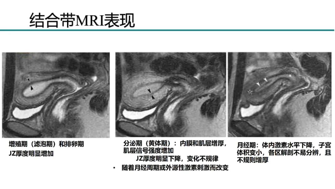 影像PPT - 【PPT】子宫内膜病变MRI诊断-13