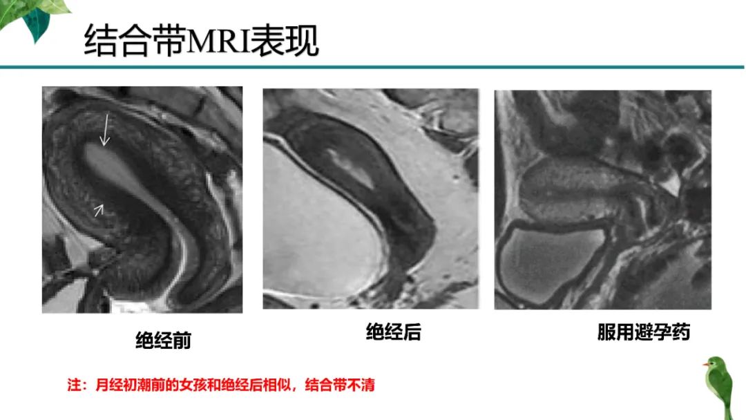 影像PPT - 【PPT】子宫内膜病变MRI诊断-14