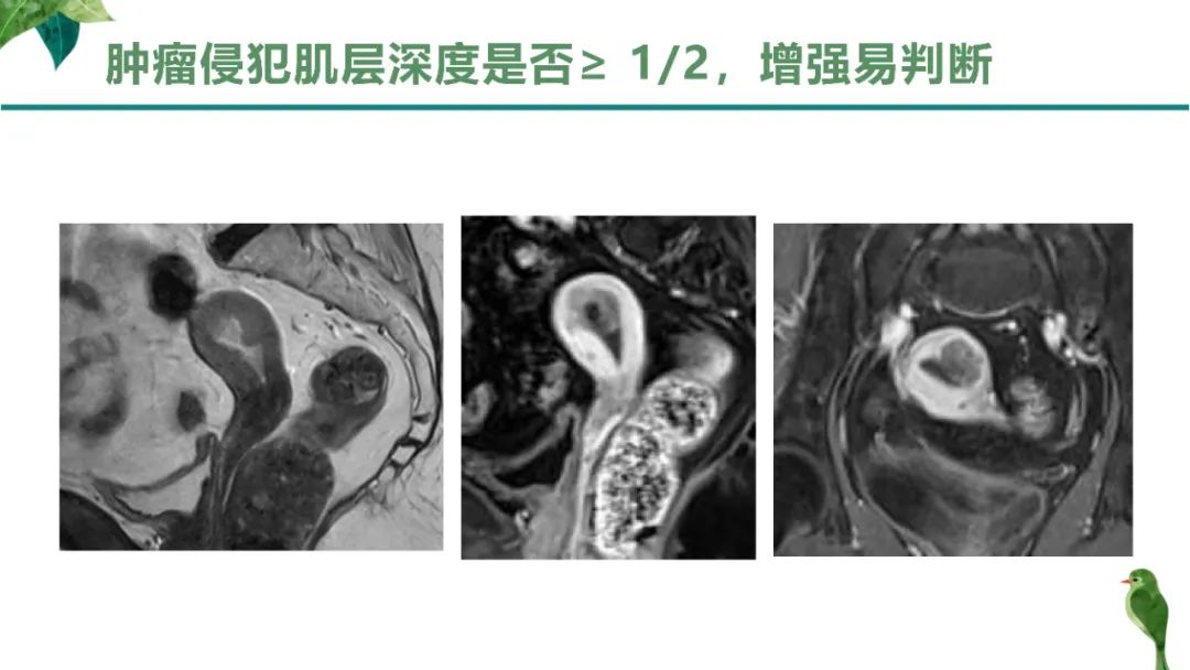 影像PPT - 【PPT】子宫内膜病变MRI诊断-25