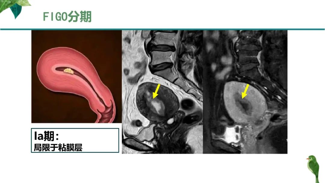 影像PPT - 【PPT】子宫内膜病变MRI诊断-26