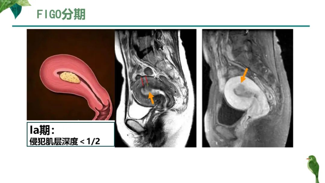 影像PPT - 【PPT】子宫内膜病变MRI诊断-27