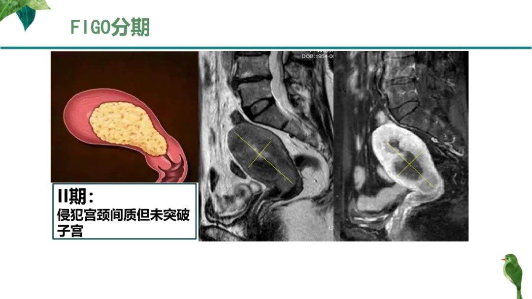影像PPT - 【PPT】子宫内膜病变MRI诊断-29