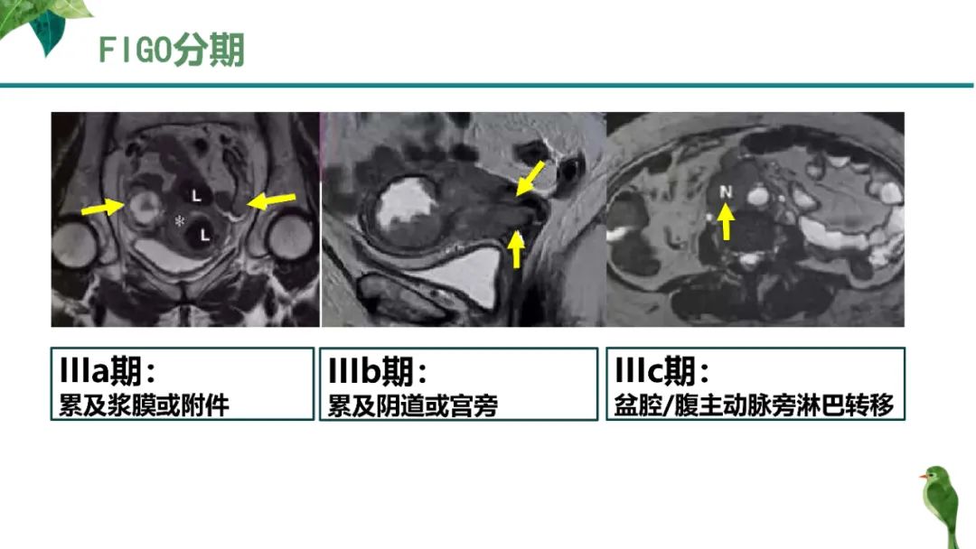 影像PPT - 【PPT】子宫内膜病变MRI诊断-30