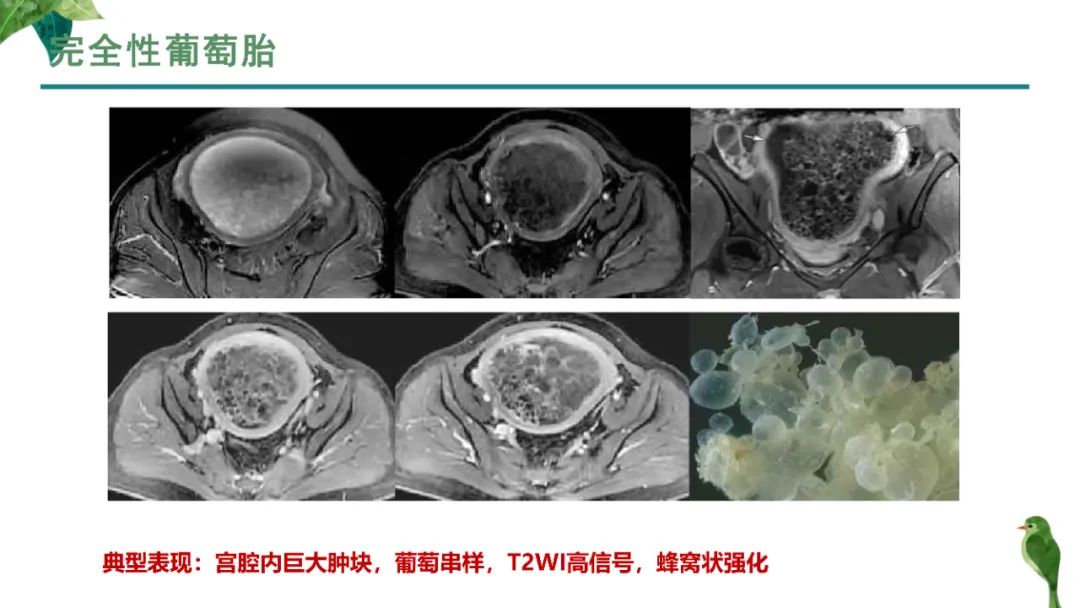 影像PPT - 【PPT】子宫内膜病变MRI诊断-37