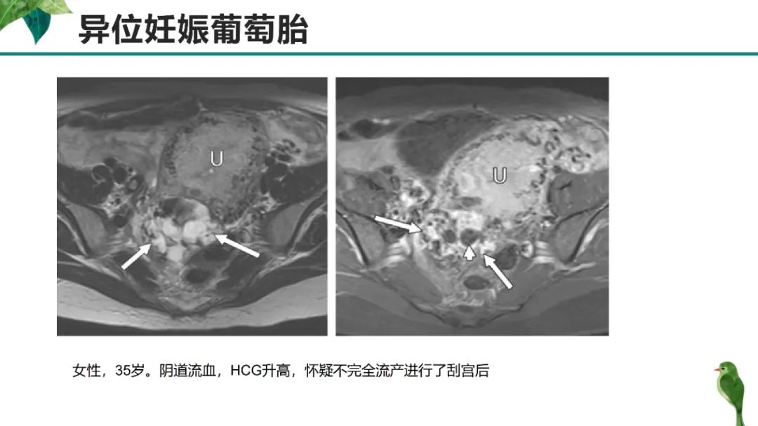 影像PPT - 【PPT】子宫内膜病变MRI诊断-40