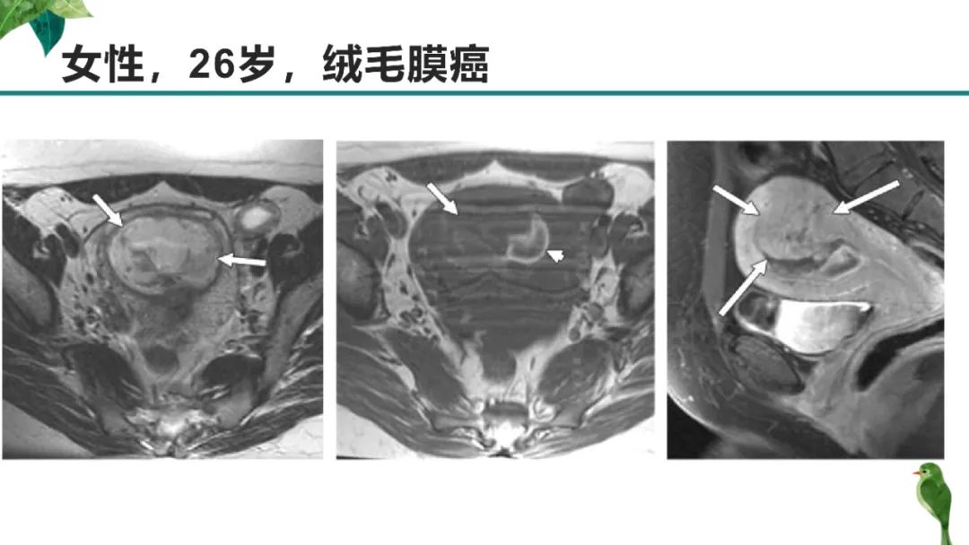影像PPT - 【PPT】子宫内膜病变MRI诊断-43