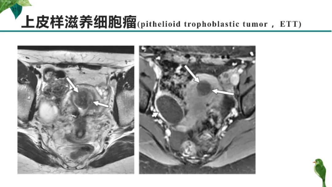 影像PPT - 【PPT】子宫内膜病变MRI诊断-45