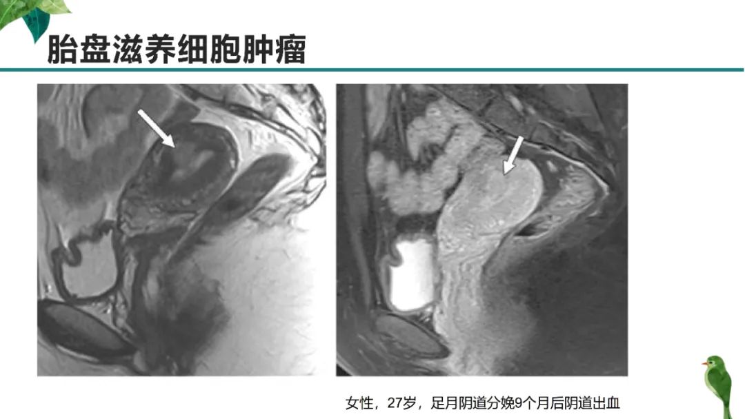 影像PPT - 【PPT】子宫内膜病变MRI诊断-44