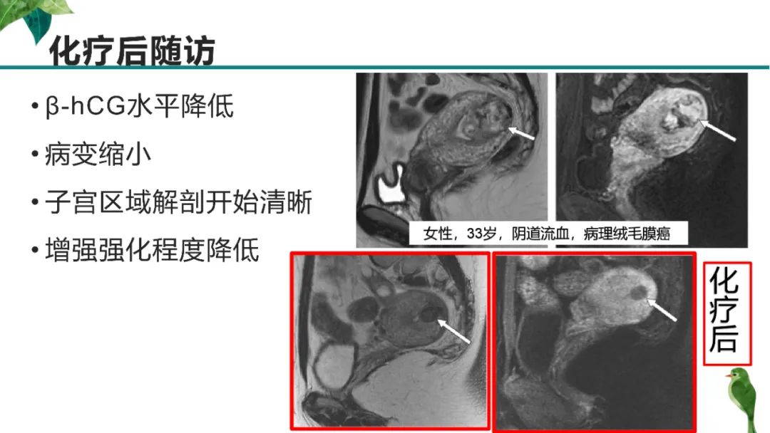影像PPT - 【PPT】子宫内膜病变MRI诊断-46