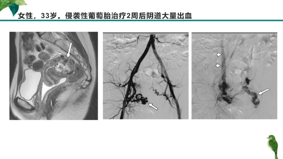 影像PPT - 【PPT】子宫内膜病变MRI诊断-47
