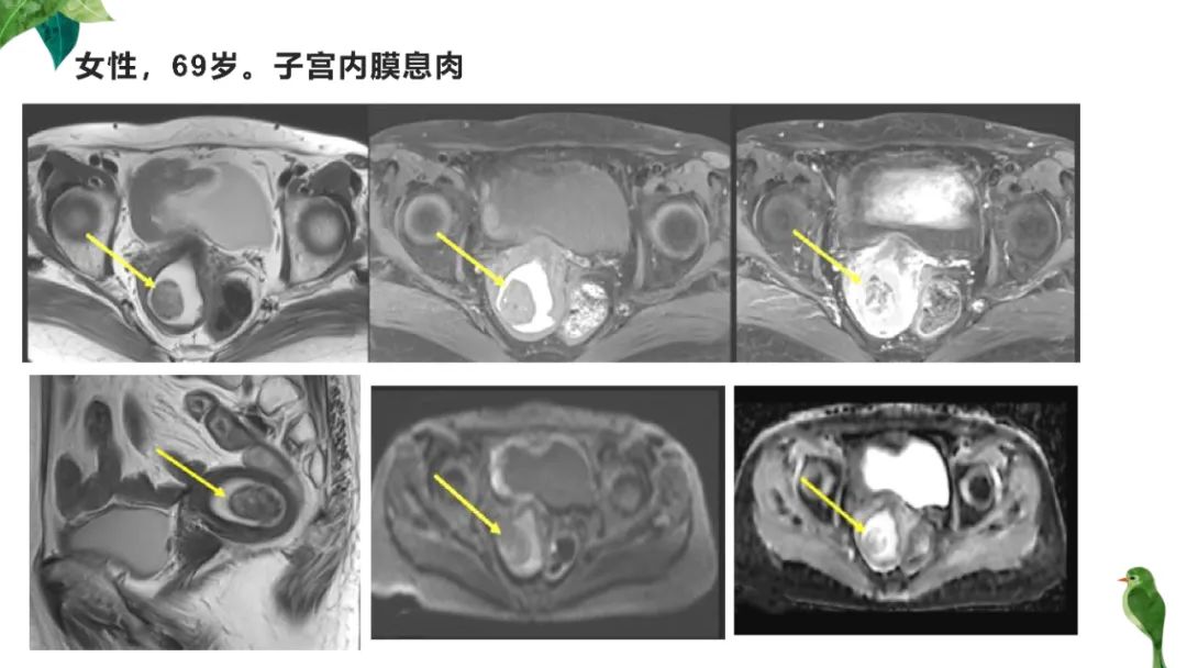 影像PPT - 【PPT】子宫内膜病变MRI诊断-52