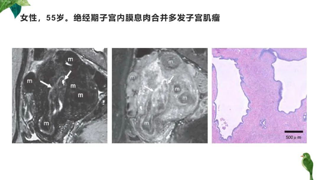 影像PPT - 【PPT】子宫内膜病变MRI诊断-55