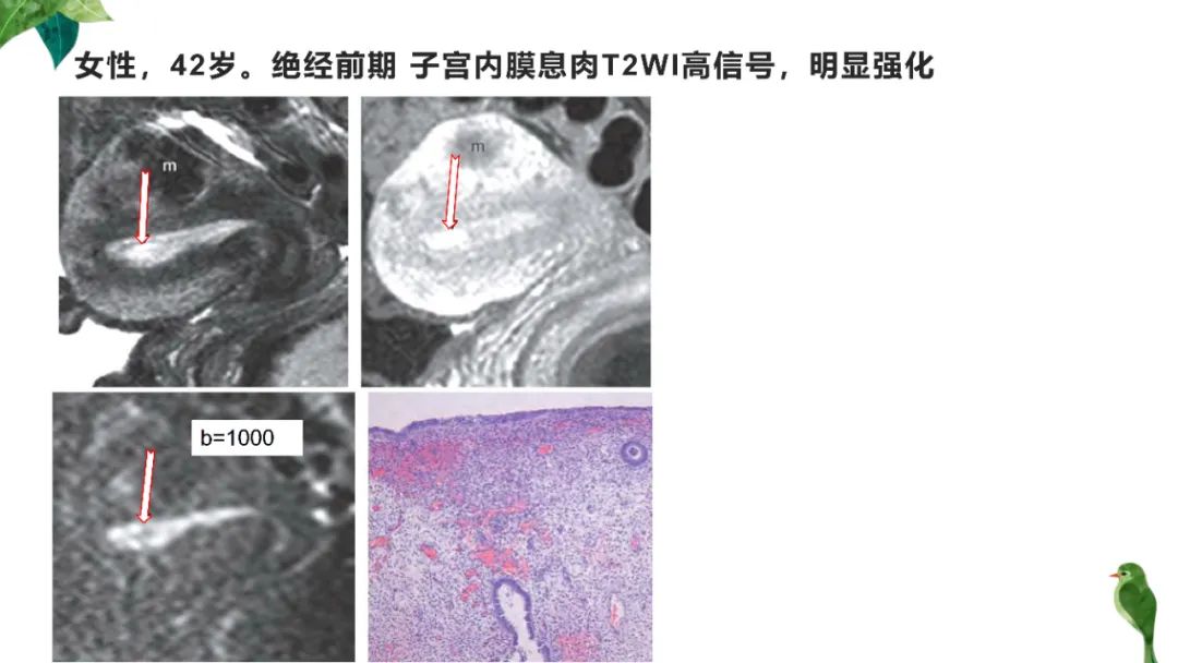 影像PPT - 【PPT】子宫内膜病变MRI诊断-56