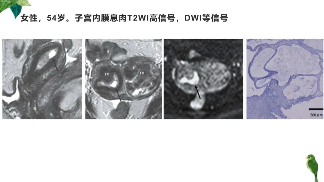 影像PPT - 【PPT】子宫内膜病变MRI诊断-57