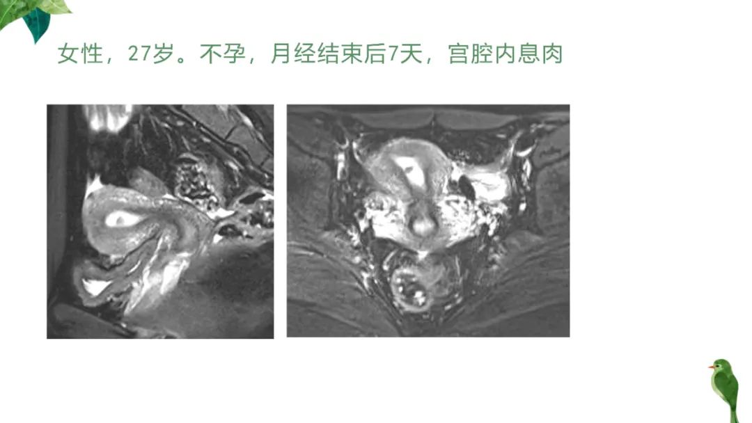 影像PPT - 【PPT】子宫内膜病变MRI诊断-59