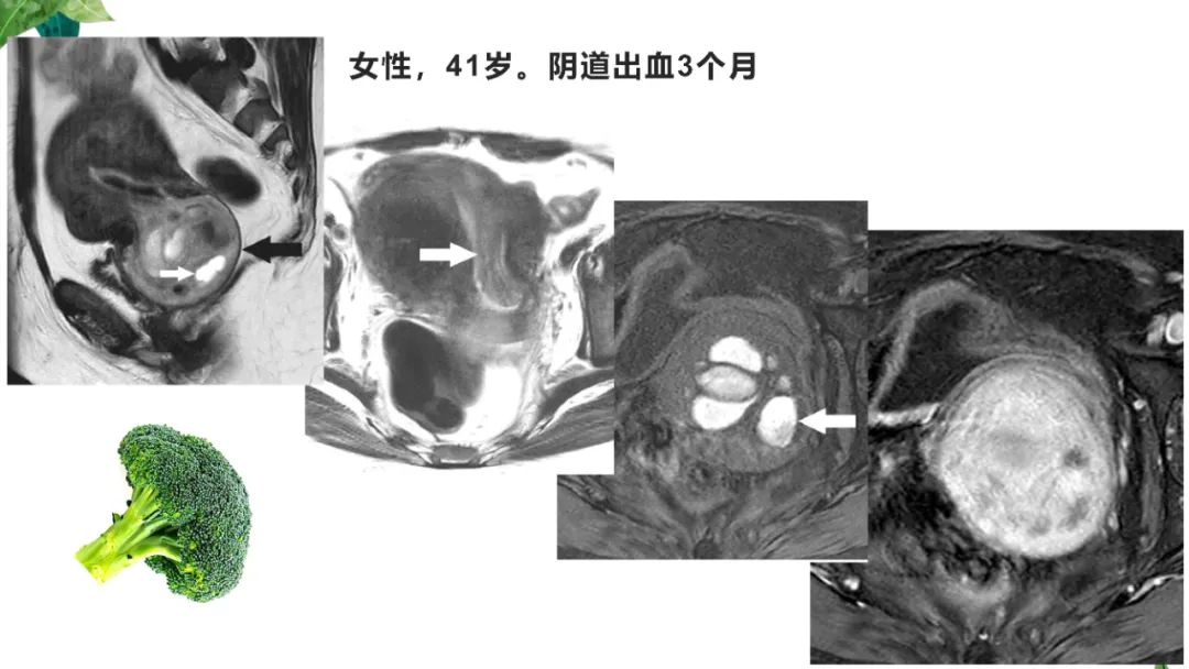 影像PPT - 【PPT】子宫内膜病变MRI诊断-62