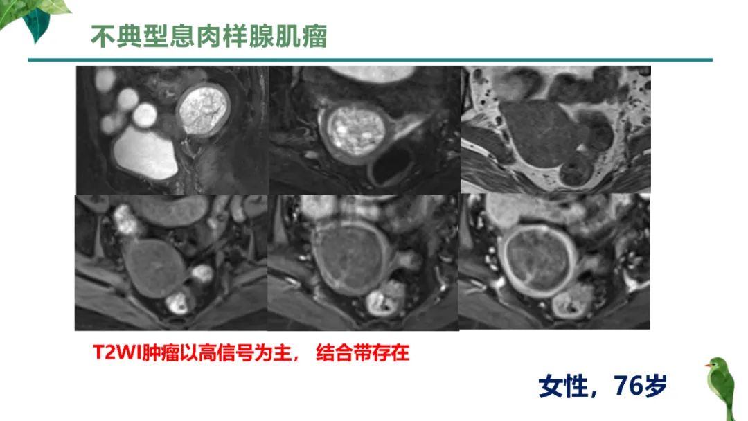 影像PPT - 【PPT】子宫内膜病变MRI诊断-65