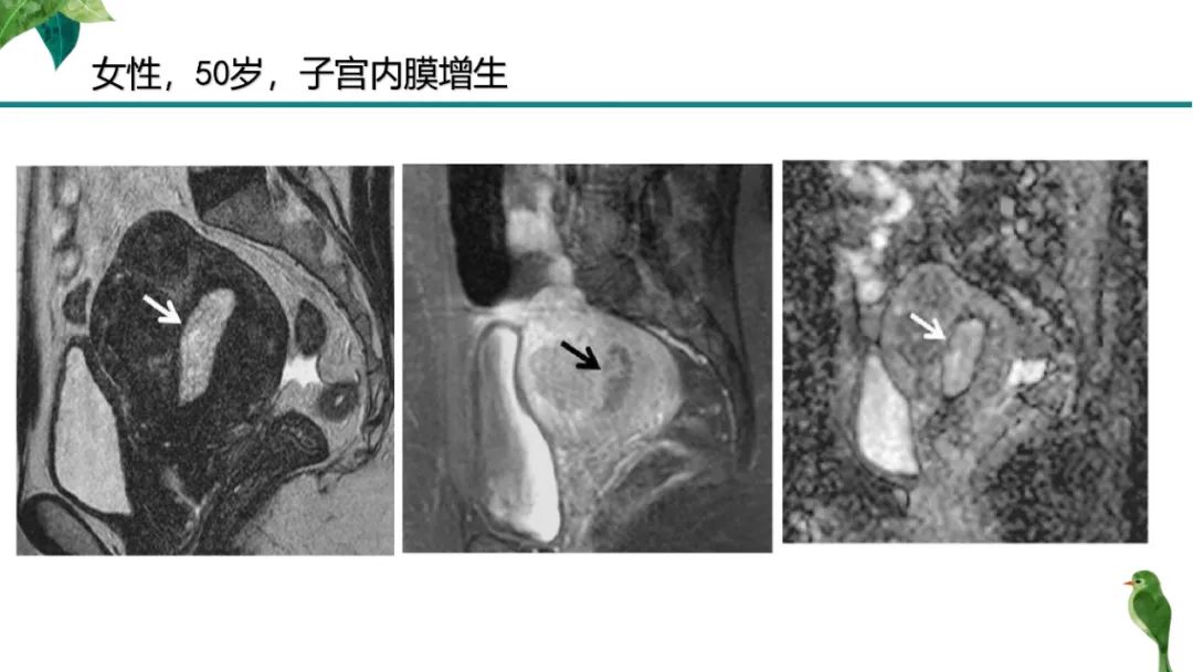 影像PPT - 【PPT】子宫内膜病变MRI诊断-70