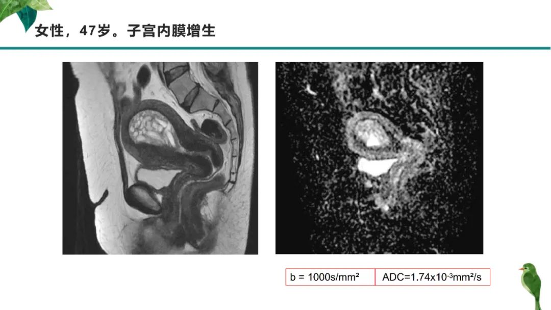 影像PPT - 【PPT】子宫内膜病变MRI诊断-69