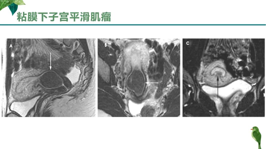 影像PPT - 【PPT】子宫内膜病变MRI诊断-75