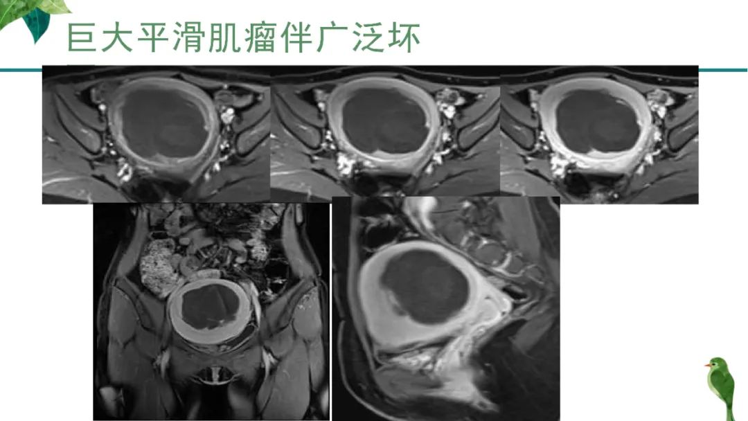 影像PPT - 【PPT】子宫内膜病变MRI诊断-81