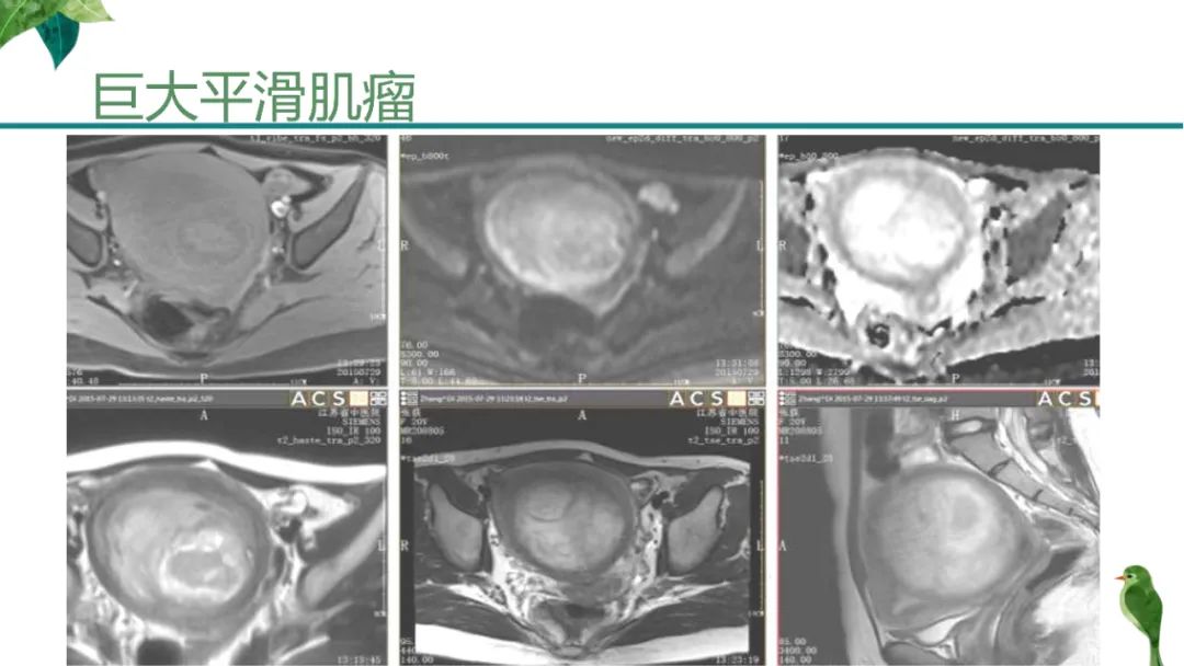 影像PPT - 【PPT】子宫内膜病变MRI诊断-80