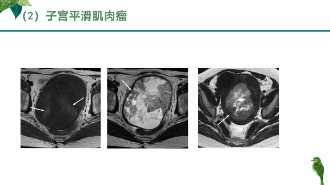 影像PPT - 【PPT】子宫内膜病变MRI诊断-84