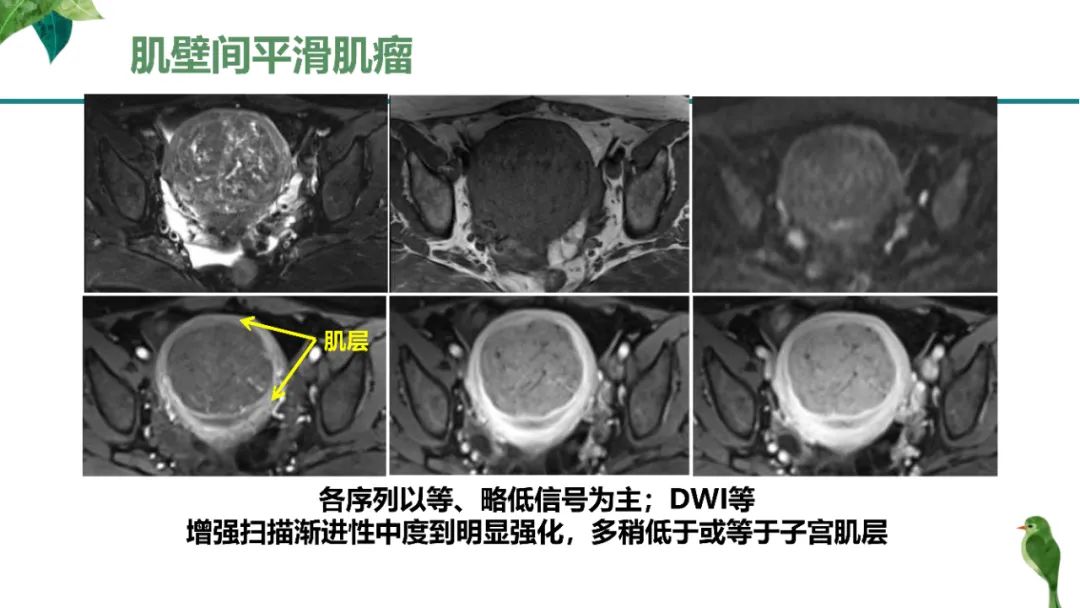 影像PPT - 【PPT】子宫内膜病变MRI诊断-82