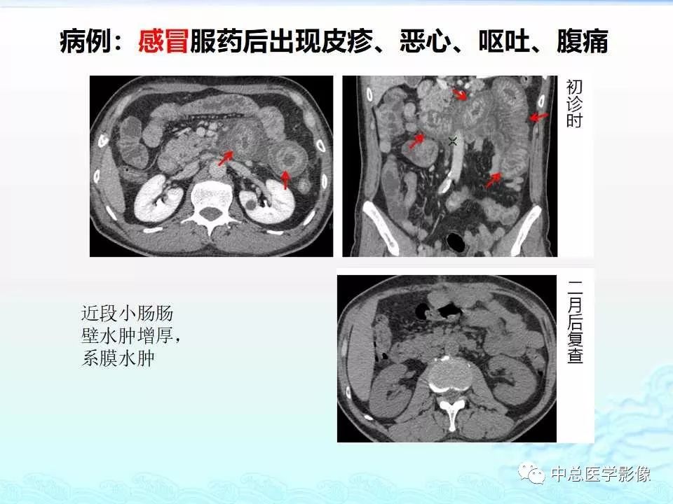 影像PPT - 【PPT】非肿瘤性肠道病变影像诊断-4