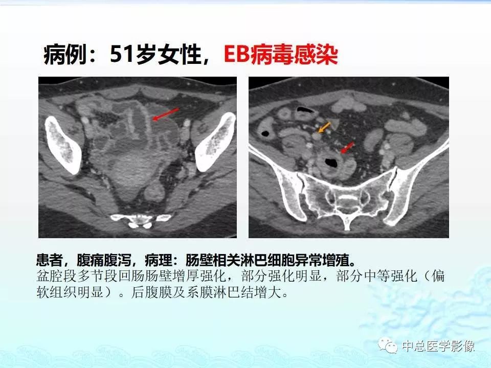 影像PPT - 【PPT】非肿瘤性肠道病变影像诊断-5