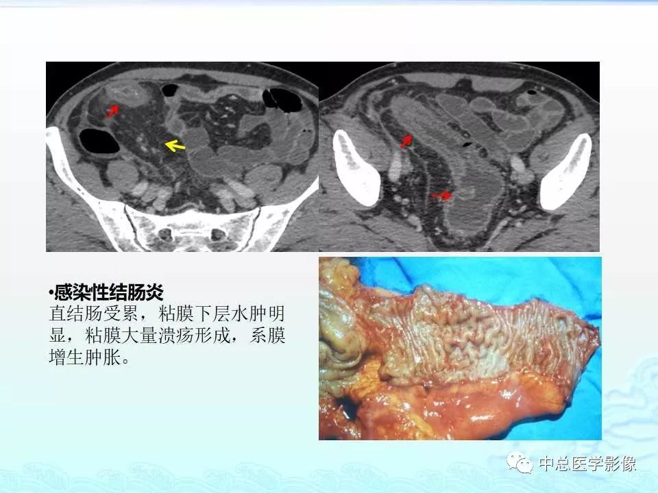 影像PPT - 【PPT】非肿瘤性肠道病变影像诊断-6