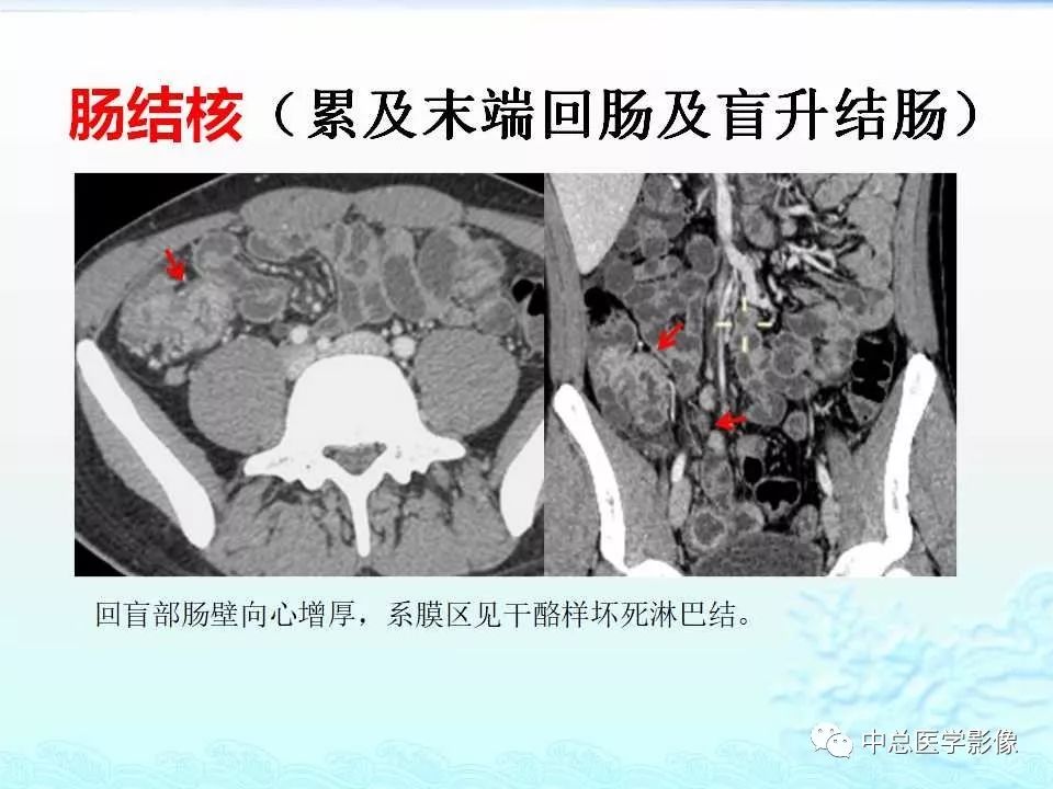 影像PPT - 【PPT】非肿瘤性肠道病变影像诊断-7