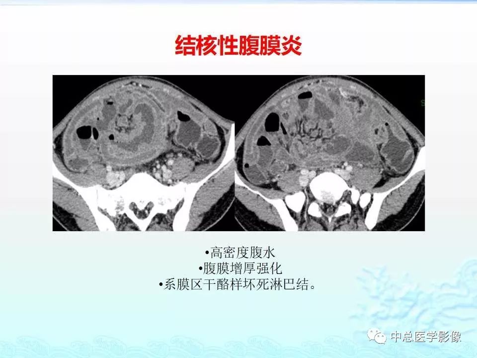 影像PPT - 【PPT】非肿瘤性肠道病变影像诊断-8