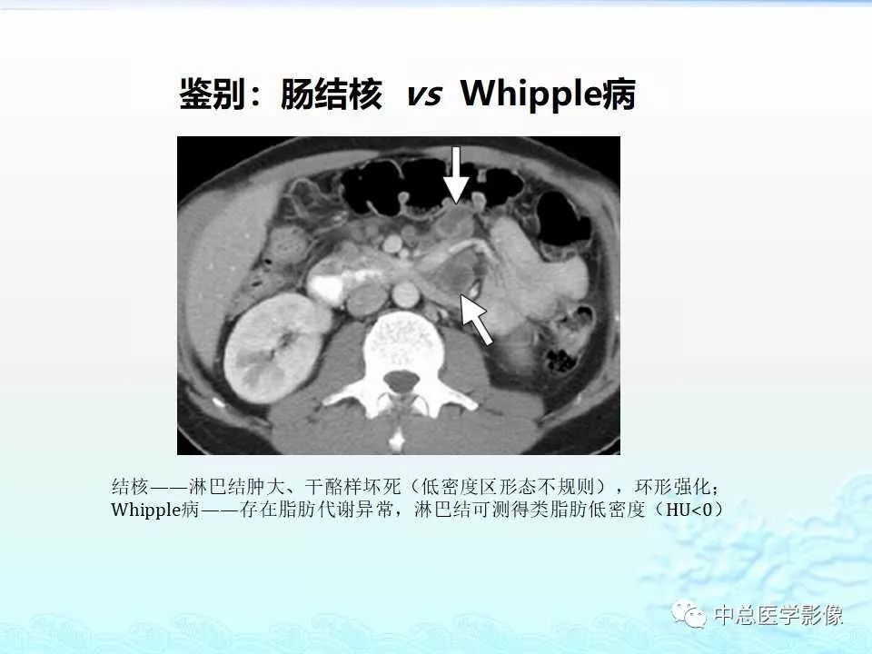 影像PPT - 【PPT】非肿瘤性肠道病变影像诊断-10