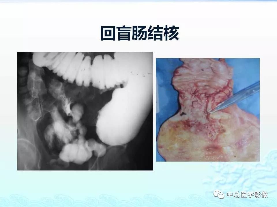 影像PPT - 【PPT】非肿瘤性肠道病变影像诊断-9