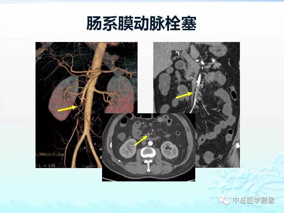 影像PPT - 【PPT】非肿瘤性肠道病变影像诊断-12
