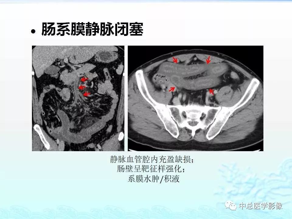 影像PPT - 【PPT】非肿瘤性肠道病变影像诊断-13