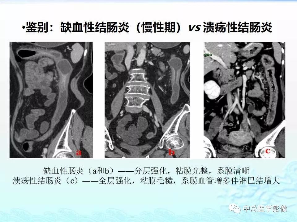 影像PPT - 【PPT】非肿瘤性肠道病变影像诊断-14