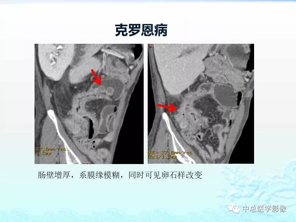 影像PPT - 【PPT】非肿瘤性肠道病变影像诊断-17