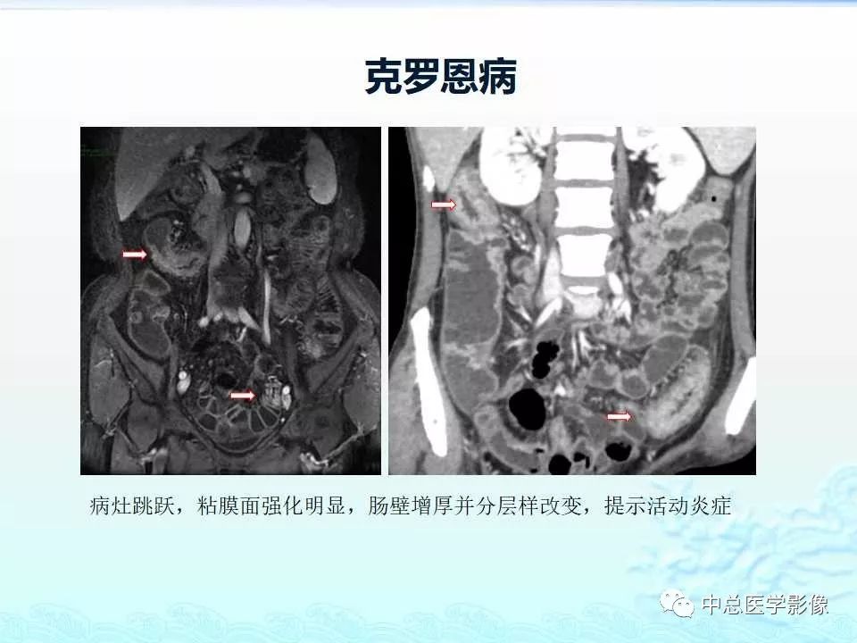影像PPT - 【PPT】非肿瘤性肠道病变影像诊断-16
